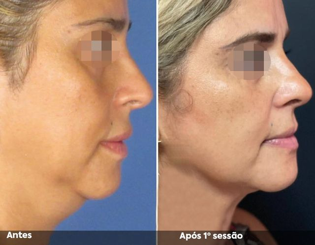 Antes e após a primeira sessão de Hipro no rosto, perfil direito