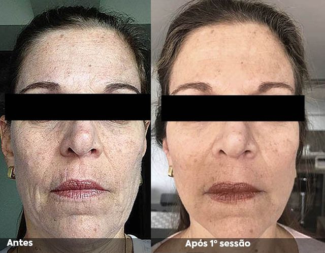 Antes e após a primeira sessão de Hipro no rosto, visão frontal