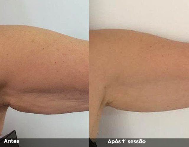 Antes e após a primeira sessão de Hipro no braço