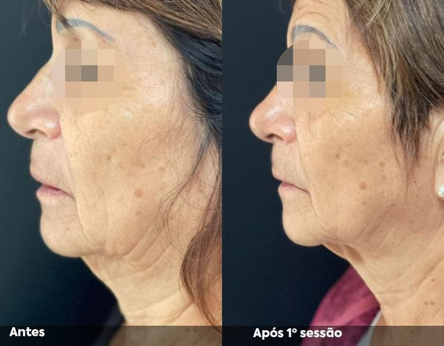 Antes e após a primeira sessão de Hipro no rosto, perfil esquerdo